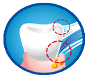 残留在牙槽深处的污垢是导致牙周炎的一个主要原因，超级细毛可以有效的清除牙槽深处的污垢。